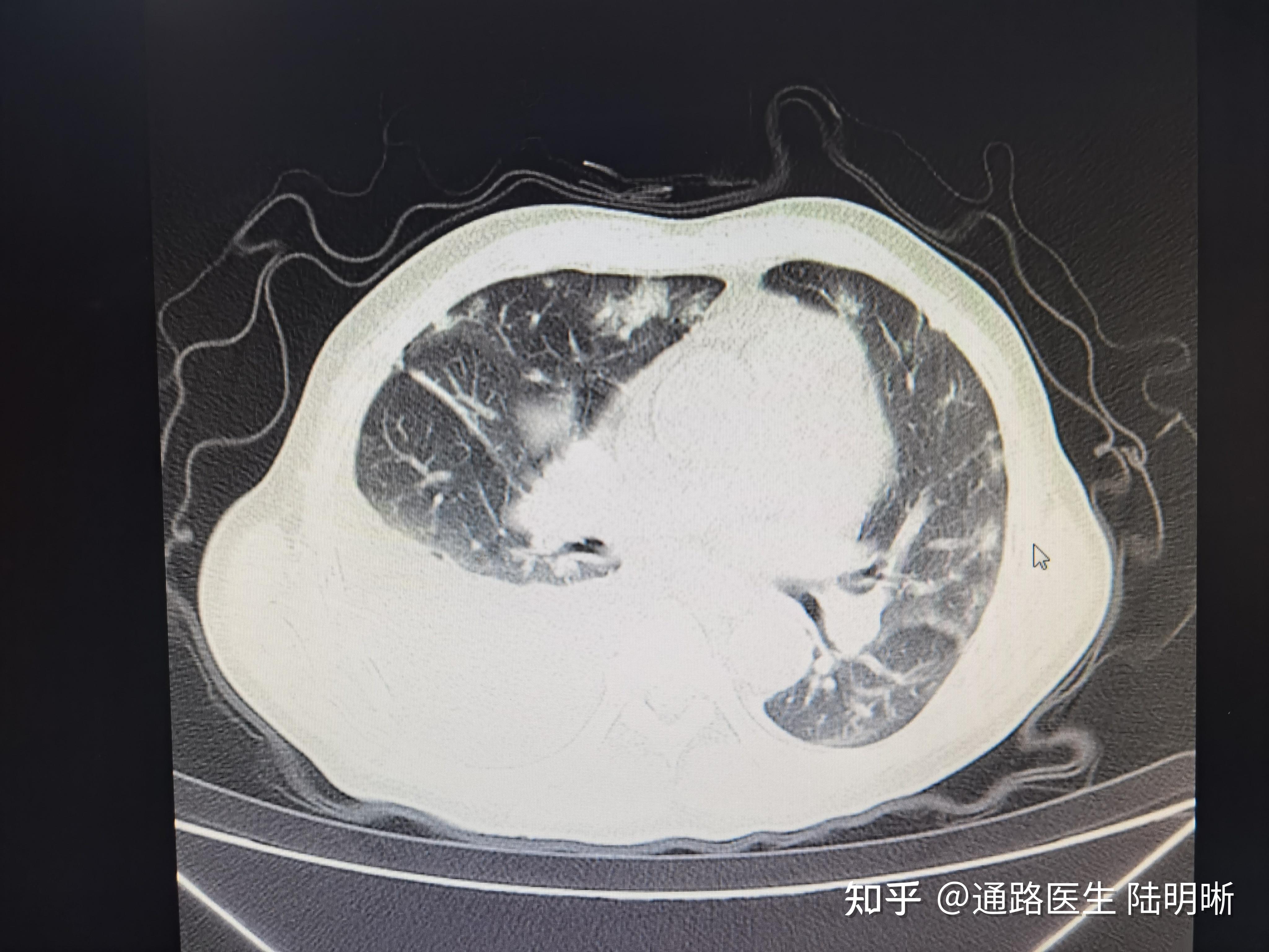 人工血管动静脉内瘘真菌感染合并真菌败血症