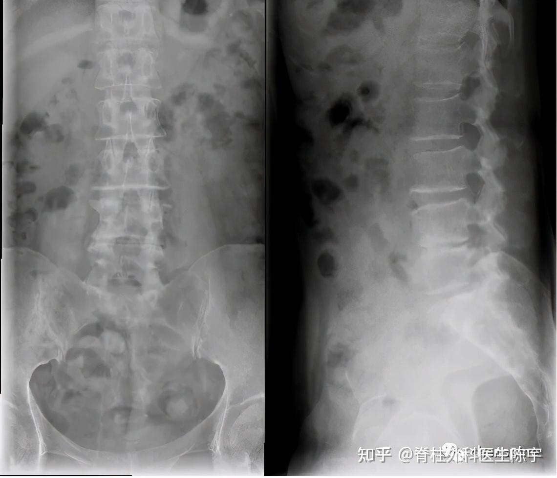 腰椎管狭窄常见问题解答