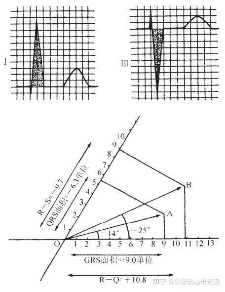 心電軸的測量方法你掌握了幾種