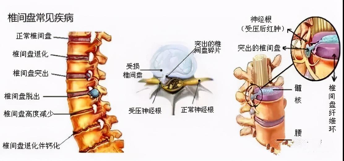 椎间盘突出示意图3D图片