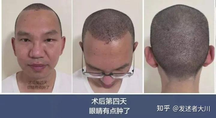 植发手术能不能做双眼皮(植发手术能不能做双眼皮呢)