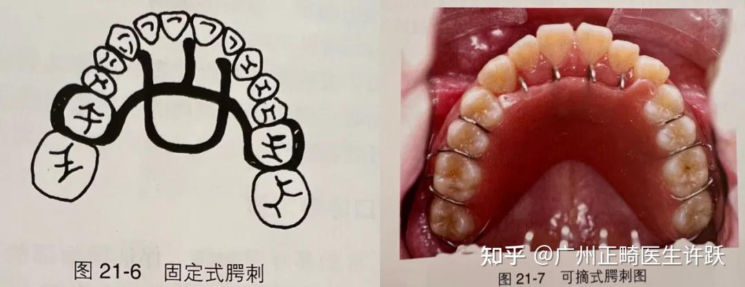 别再乱选矫治器!儿童到青少年矫牙工具大盘点,家长必看 - 知乎