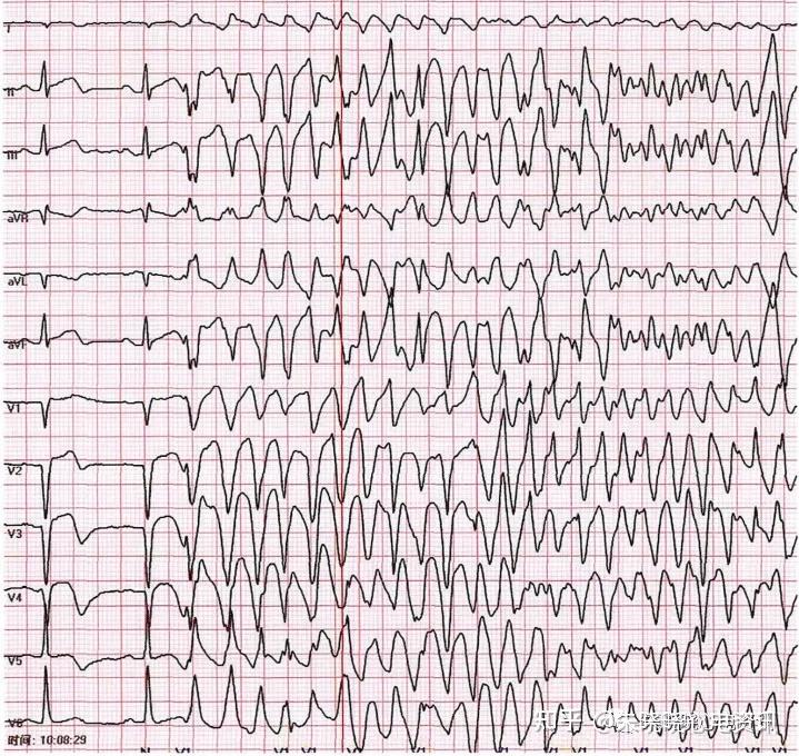 某些快速性心律失常,如室撲,室顫,持續性室速,尖端扭轉型室速,多形性