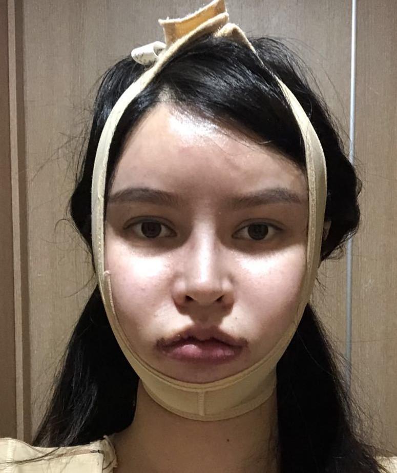 成都面部吸脂案例分享丨告别我的双下巴