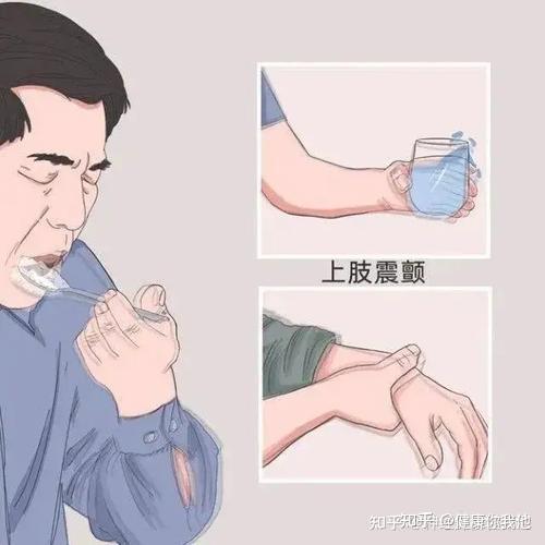 手抖是帕金森病吗？30岁手抖可能是家族遗传，教你分辨三种手抖 - 知乎