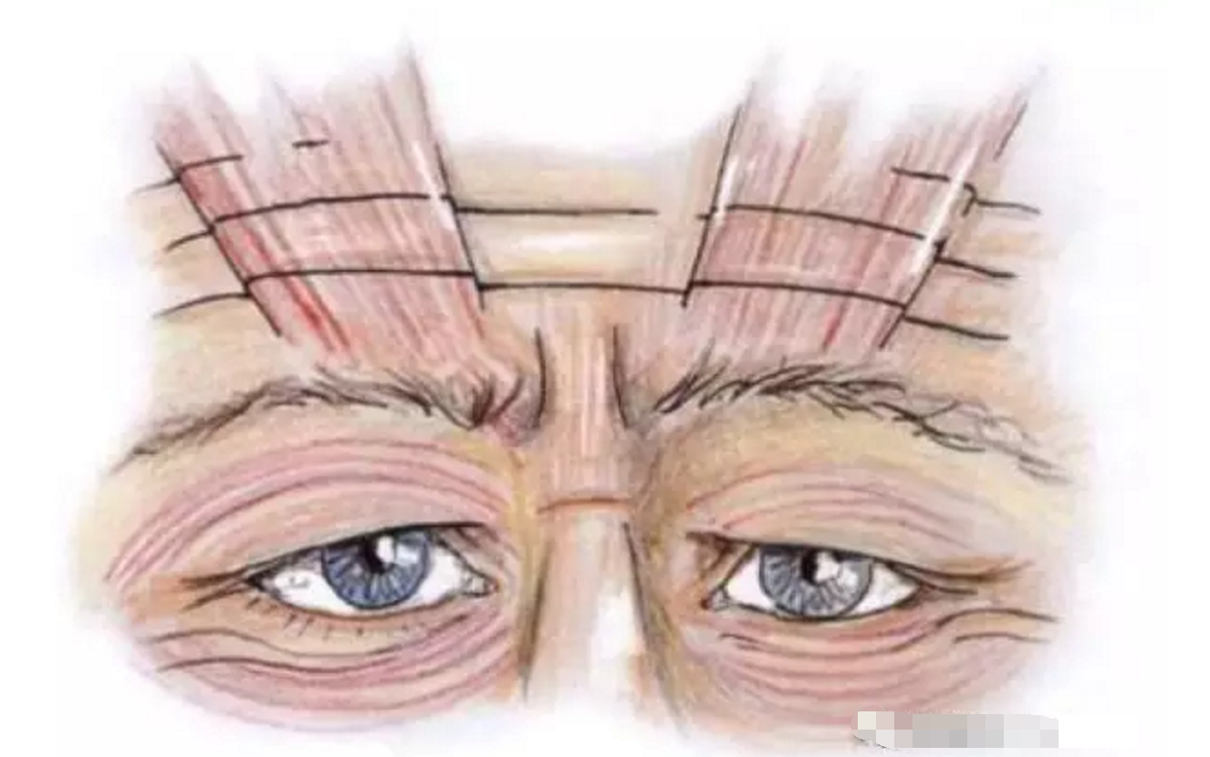 双眼皮手术究竟有哪些方法?生物焊接双眼皮、