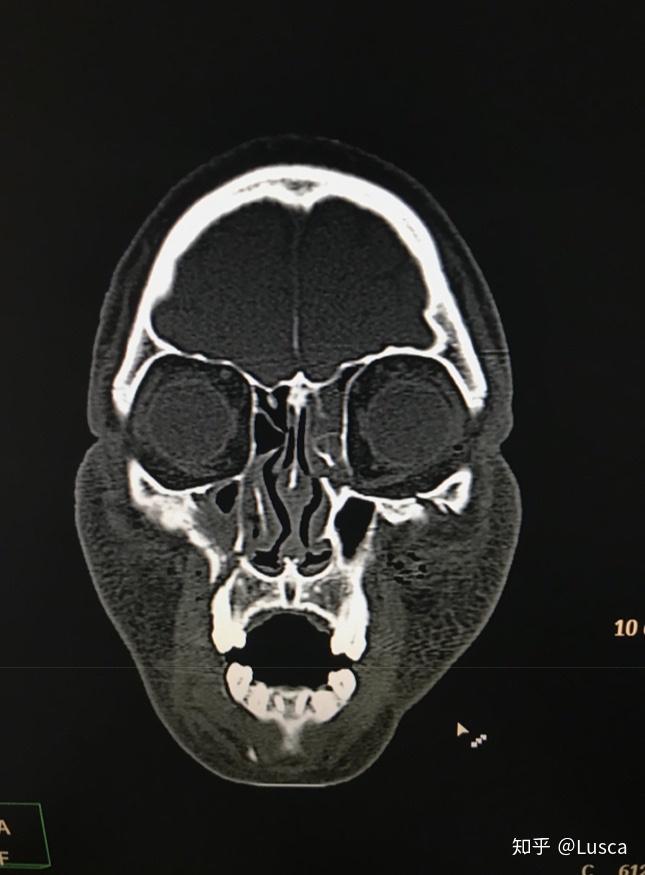 严重的颅面部骨折lefort骨折