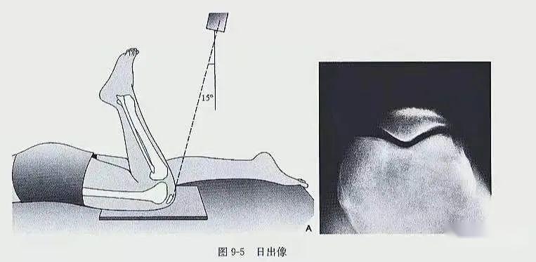 三.髌骨轴位片4.