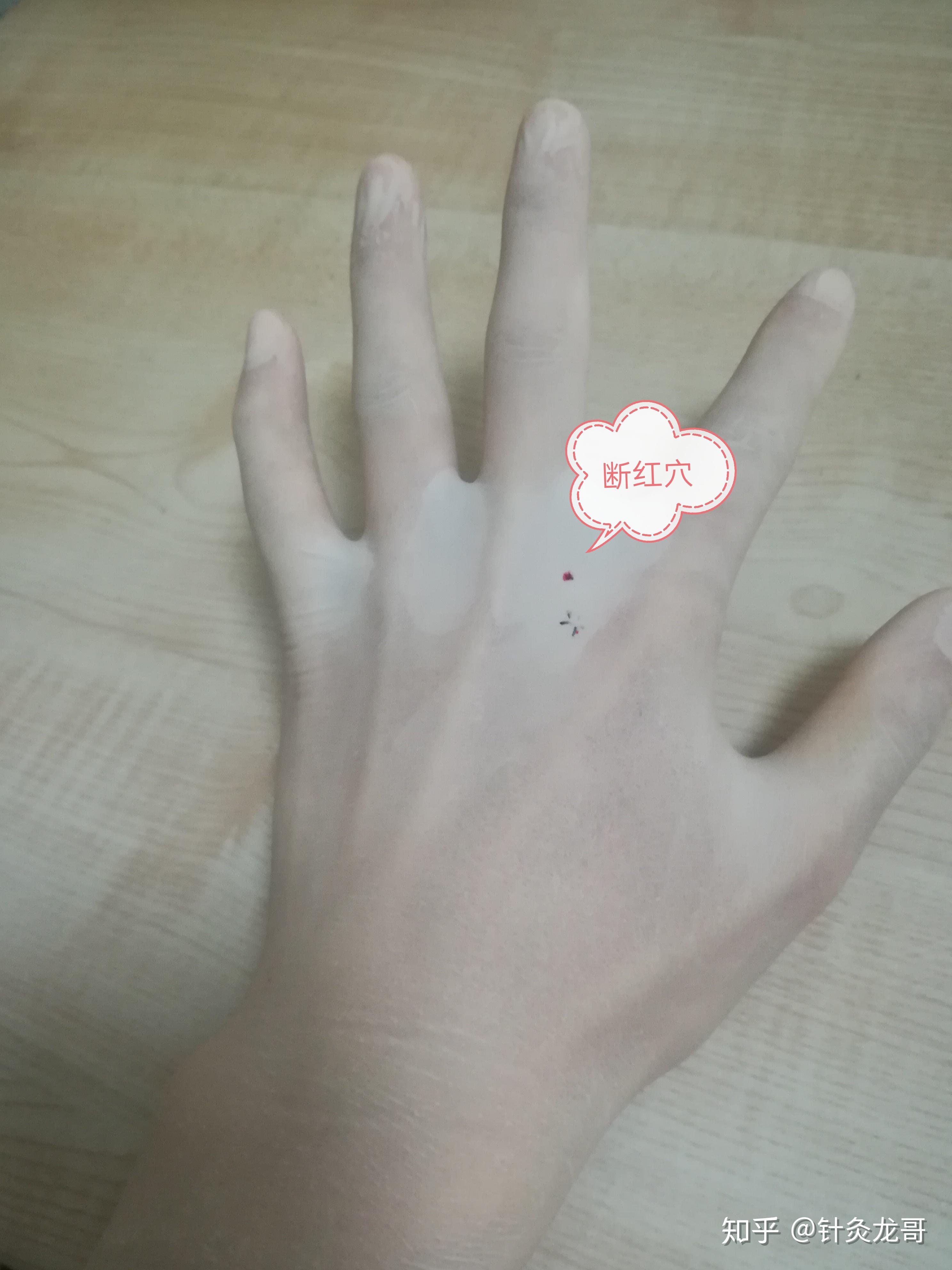 麦粒灸隐白穴治疗经间期阴道出血