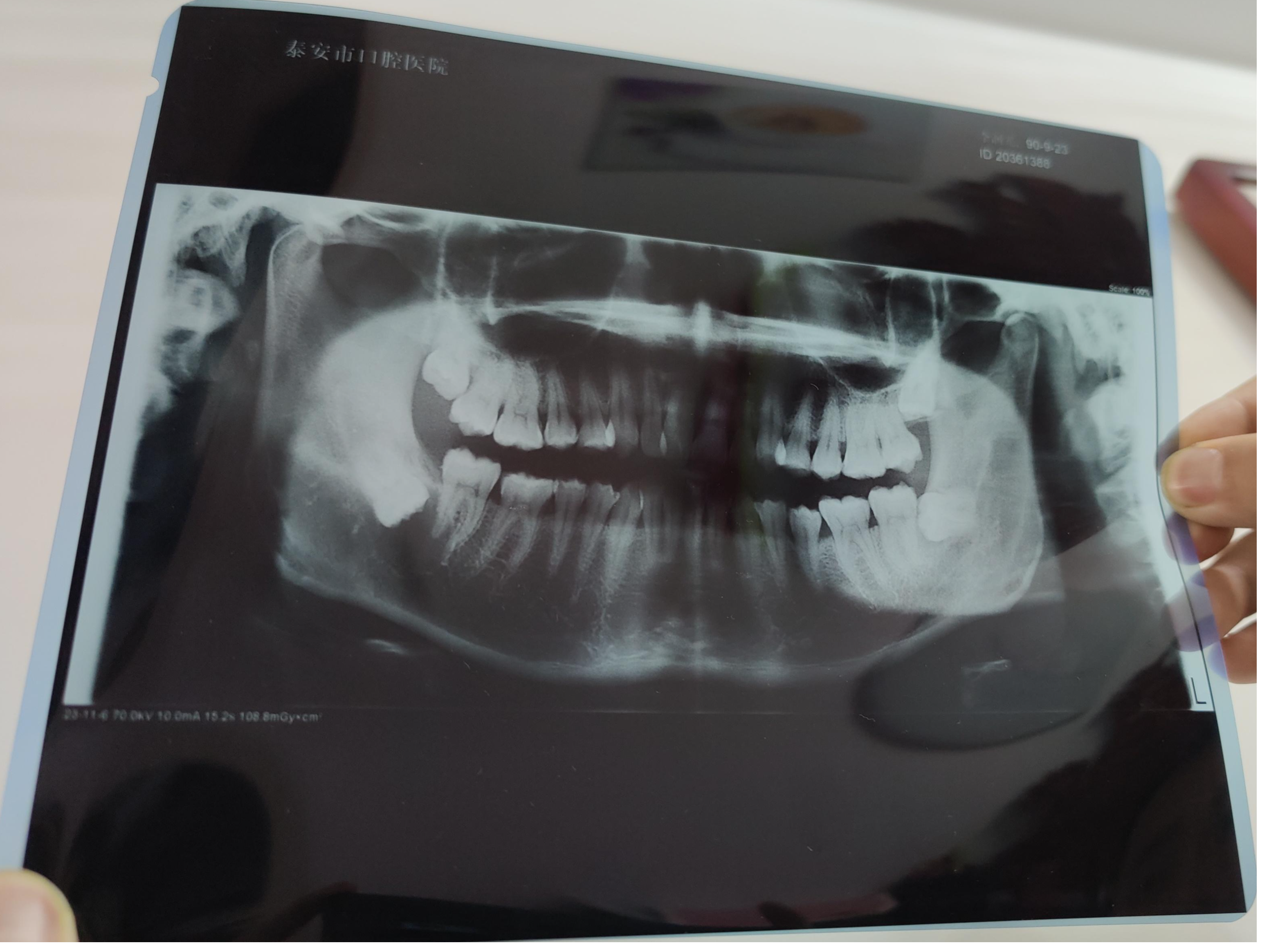 泰安中心医院口腔颌面外科做了btct,确定了左下颌,右下颌两颗含牙囊肿