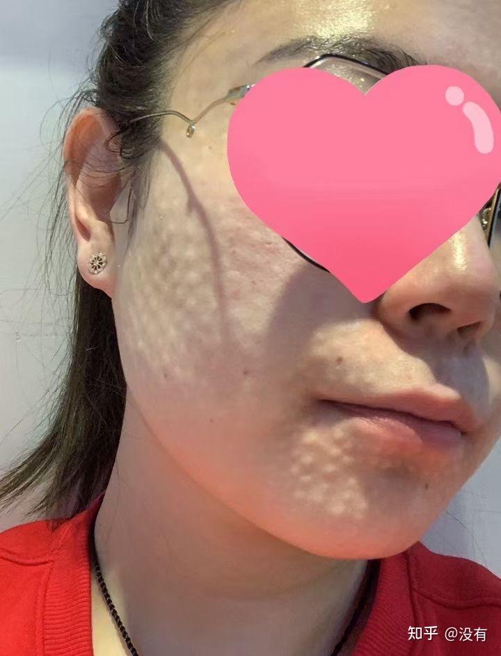实现水光针自由