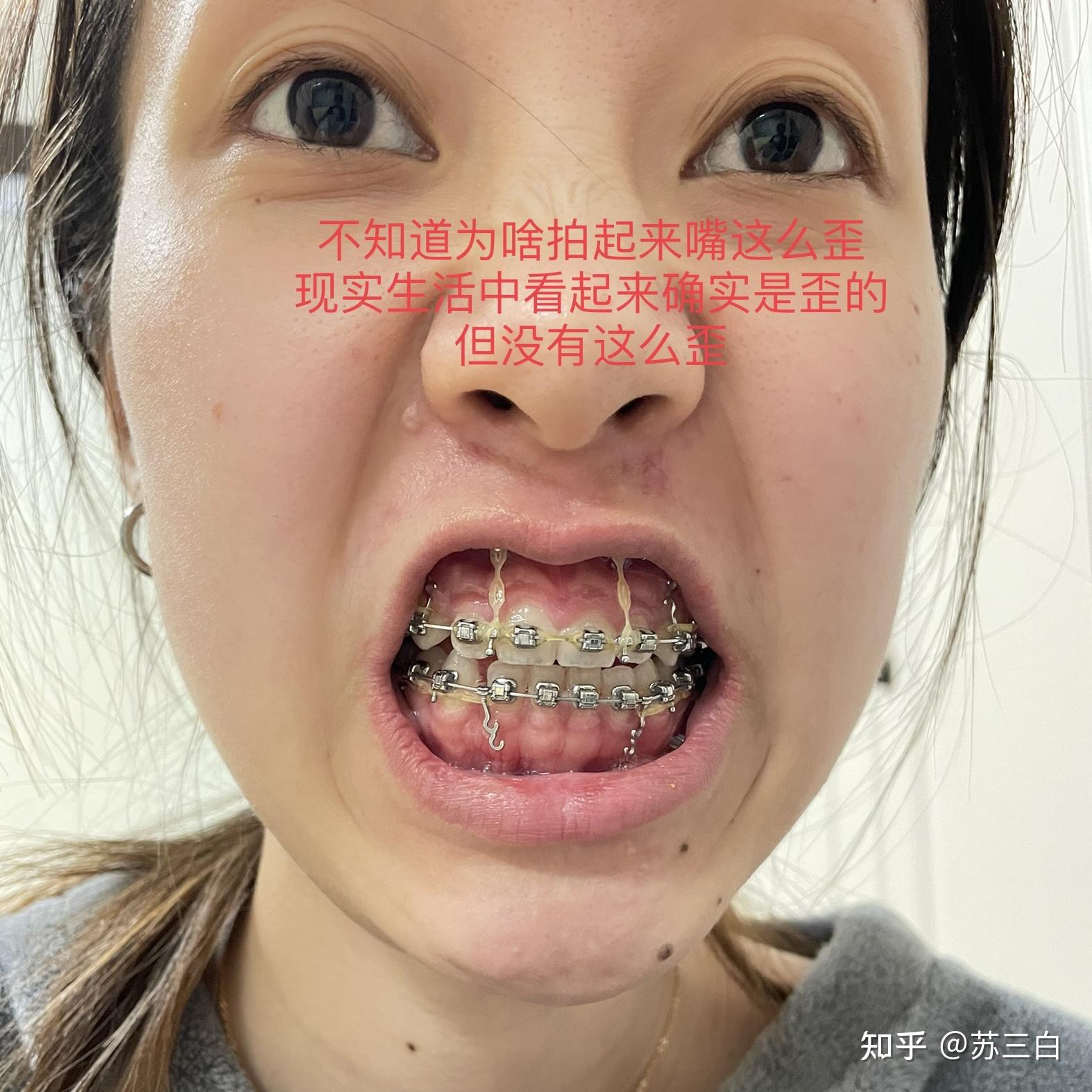 骨性嘴凸，牙齿矫正，上海口腔病防治院 - 知乎