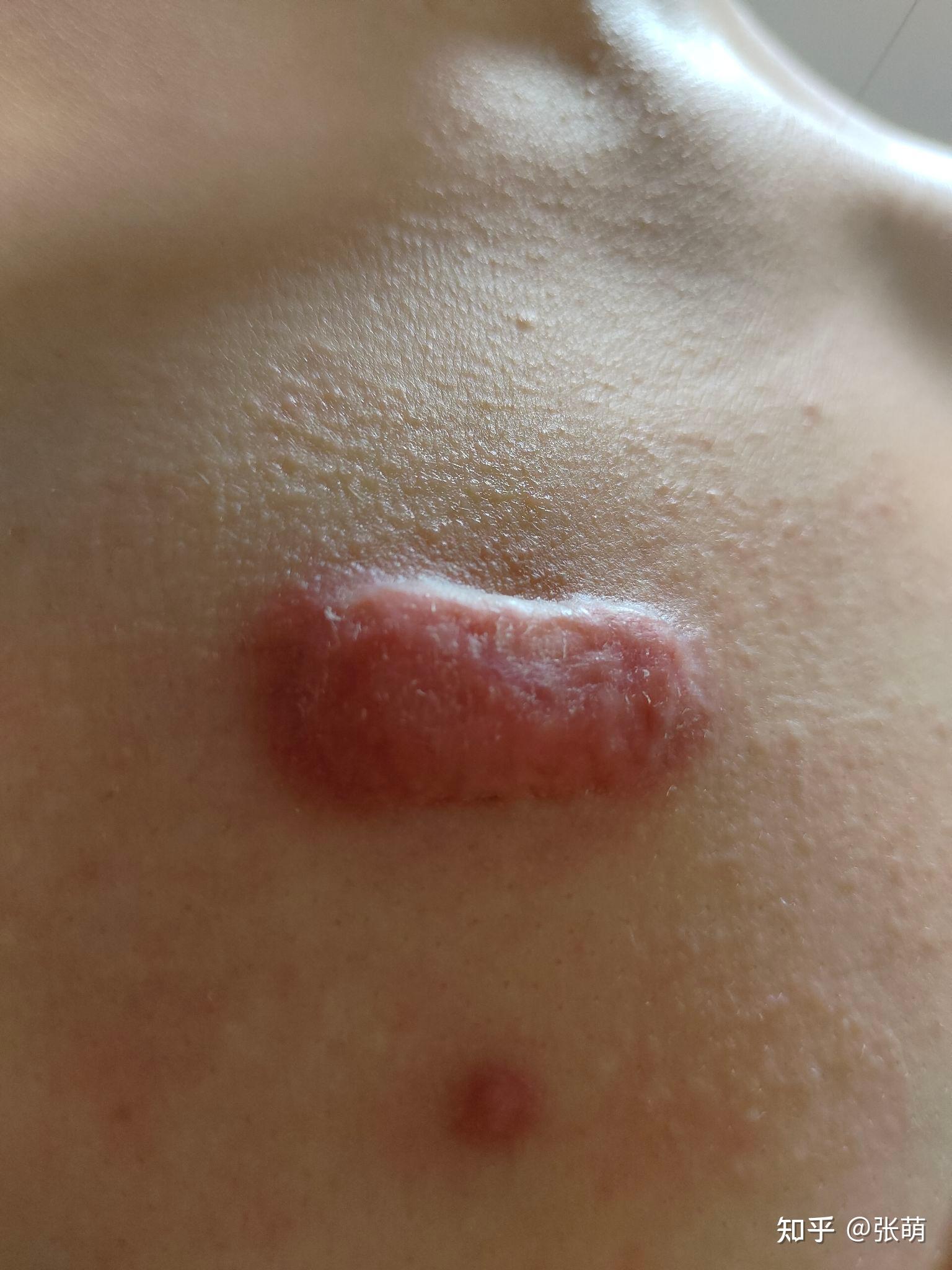 瘢痕疙瘩同位素治疗
