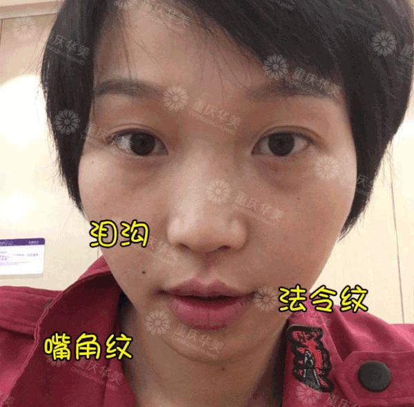 她被狂夸50天后整容式换脸凹陷脸不填充就有救