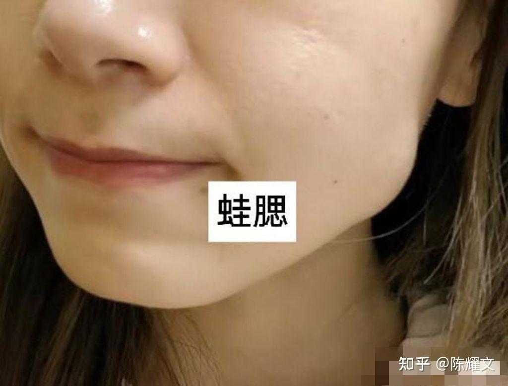 刚打完瘦脸针,竟然出现了蛙腮的情况? - 知乎