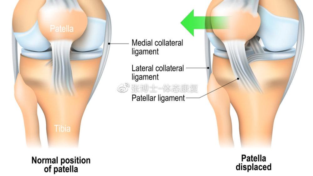 运动康复科普预防髌骨脱位膝关节疼痛要做这些髌骨稳定性训练