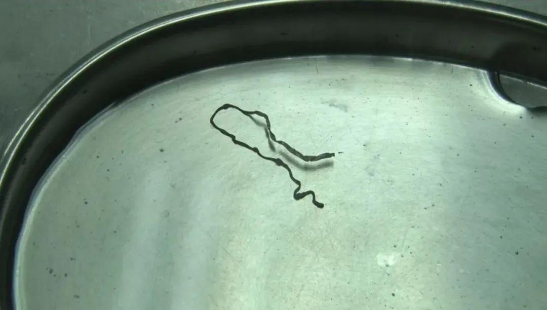 后通过手术取出一条12厘米长的蠕动活虫体,鉴定为曼氏迭宫绦虫裂头蚴