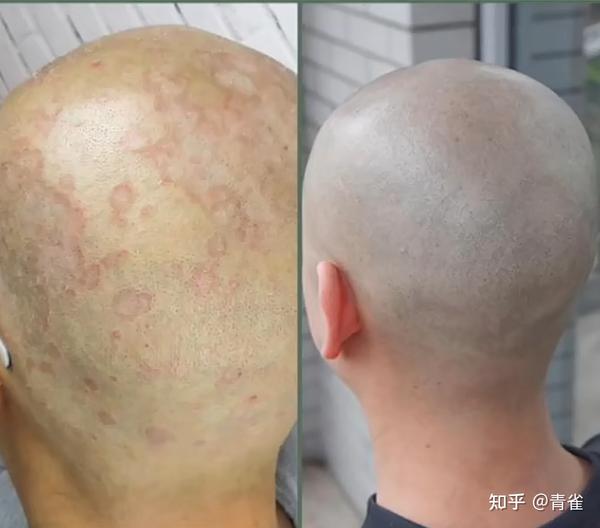 为什么抠下来大块的头皮屑会有瞬间的快感? - 知乎