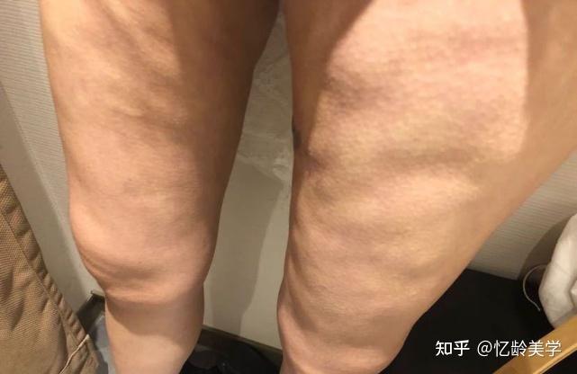 抽脂术后大腿上凹凸不平的效果 但医美机构否认了刘女士的说法,声称已