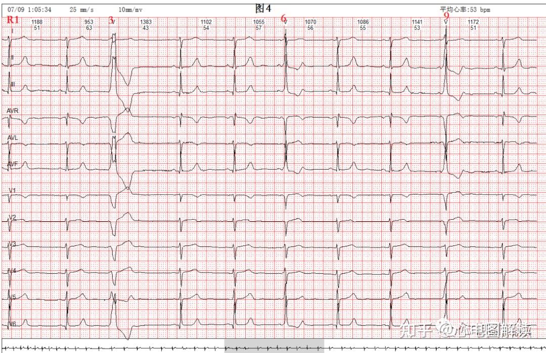 基础心律为窦性心律r6,r9是室性早搏r3为窦﹣室室性融合波