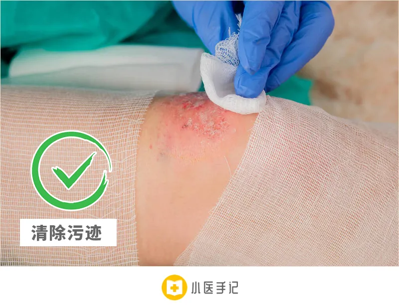 皮肤擦伤、刺伤怎么办? - 知乎