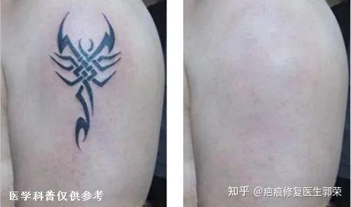 激光祛纹身圆你参军梦l有洗纹身需求的一定要提前安排起来哦
