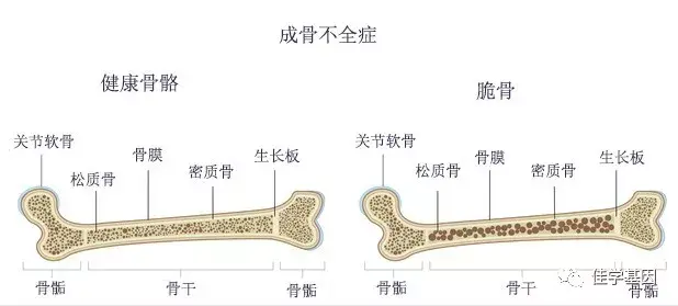 成骨不全症(osteogenesis imperfecta,oi),又称成骨不全,脆骨病,先天