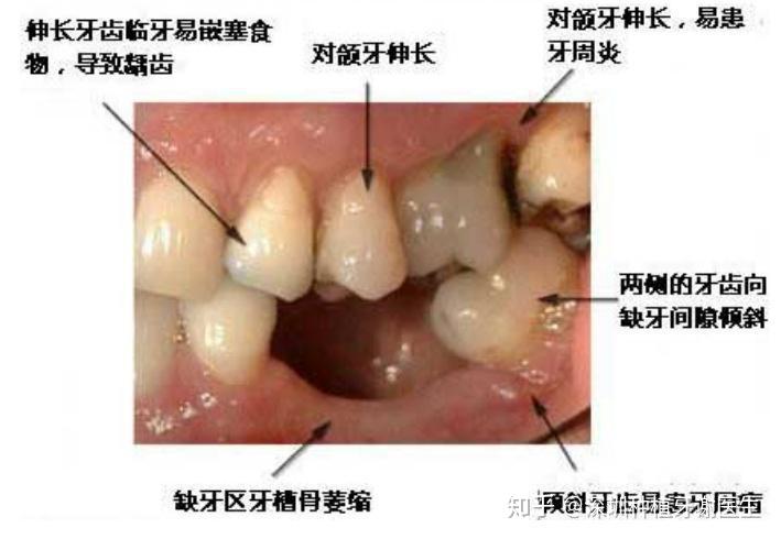 牙齿缺失有哪些危害