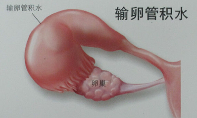 怎么结扎了还怀孕 v2-c1d67178066f969aa2973f0c4594667a_1440w.jpg?source=172ae18b