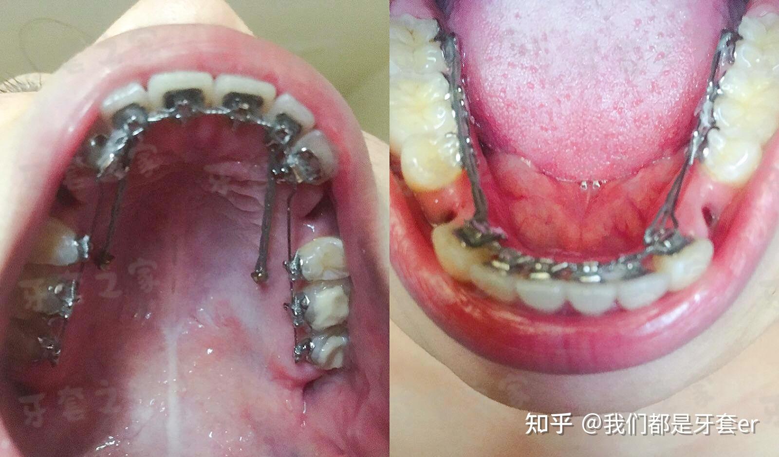 ebrace舌侧矫正骨性龅牙露龈笑拔了4颗4号牙矫正每天变一点三年大变样