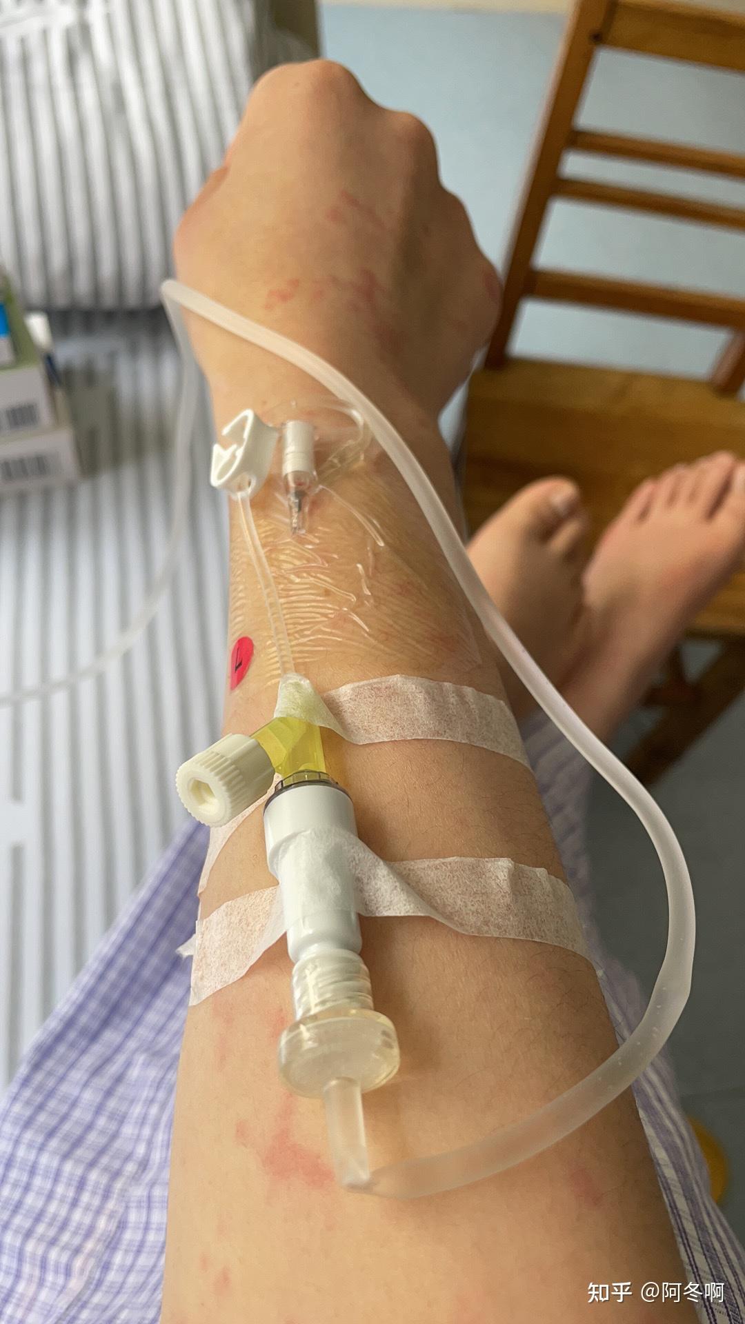 记一次荨麻疹治疗之路