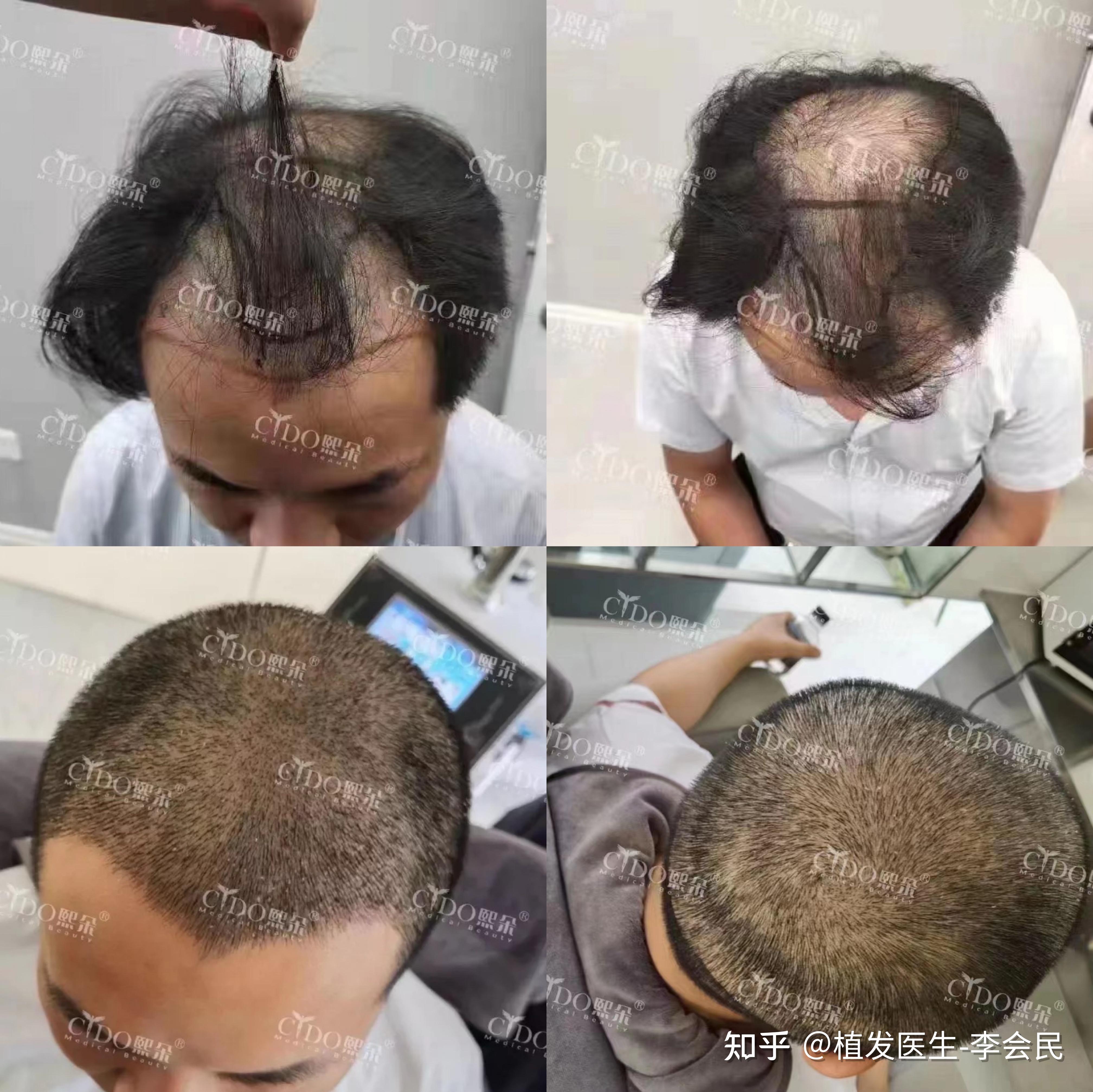 孩子植发年龄(小孩植发最早年龄是多少)