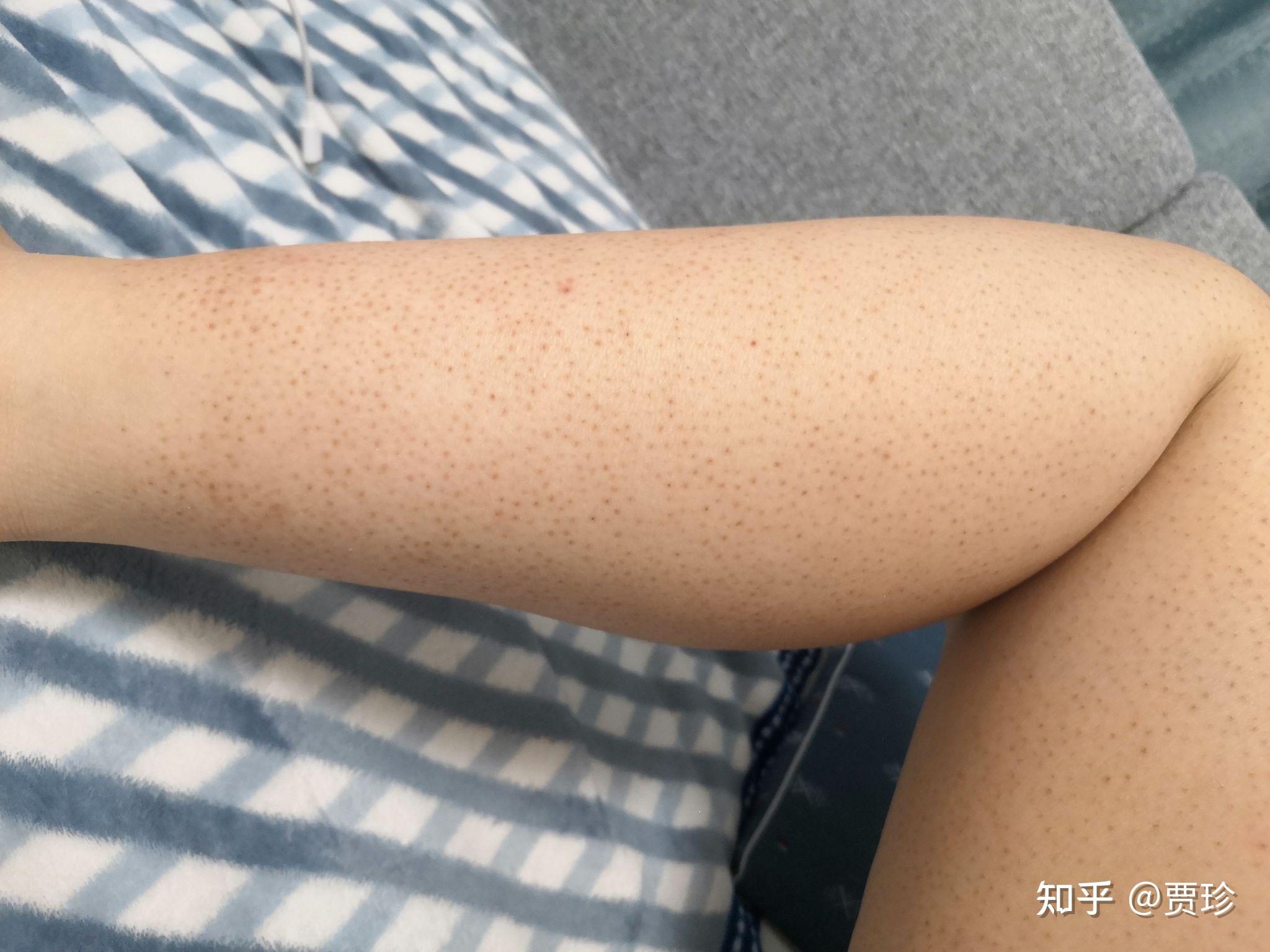 脱毛之后鸡皮肤身体变化(脱毛会使鸡皮肤更加严重吗)
