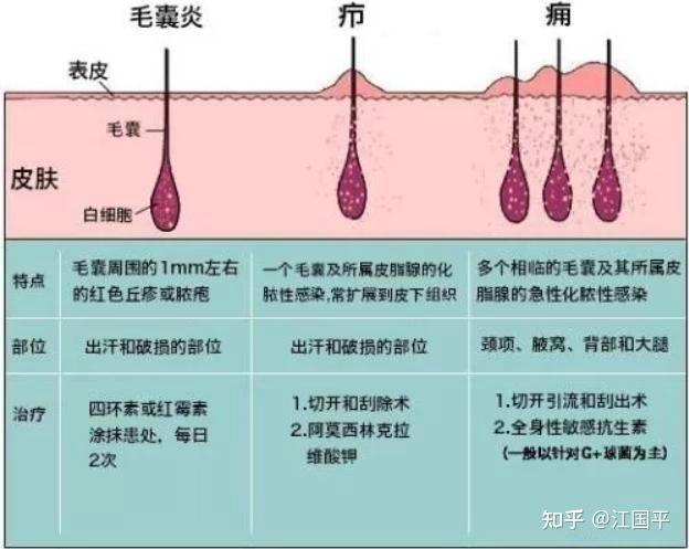 深部毛囊炎影響整個毛囊,一般更為嚴重.