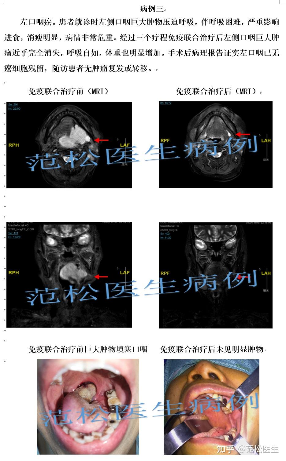 口腔癌和口咽癌术前新辅助免疫治疗病例分享 - 知乎