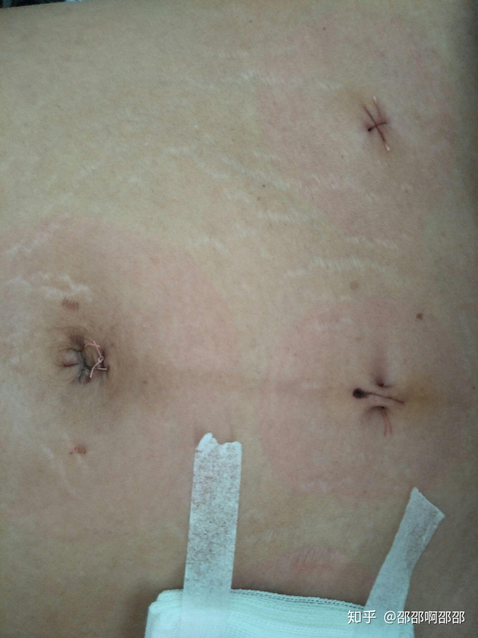 卵巢囊肿手术伤口图片图片