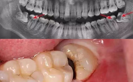 科普篇 智齿到底要不要拔 知乎