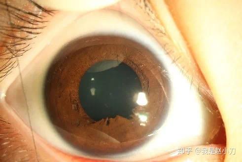 当瞳孔缩小时,残膜面积几乎占满瞳孔,严重影响视力;残膜和晶状体粘连