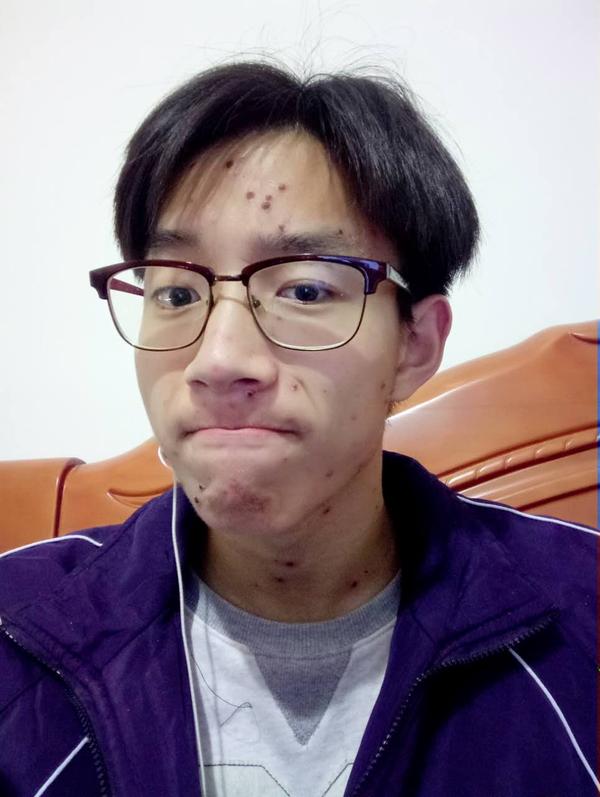 成人水痘 - 知乎