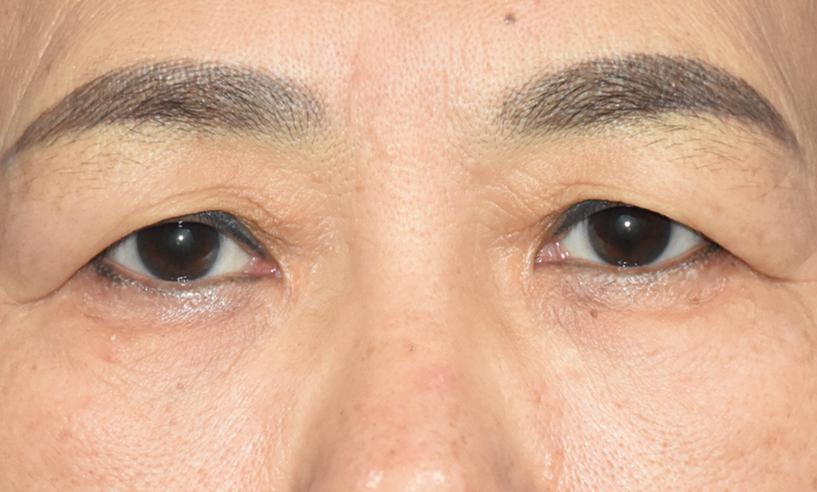 上睑皮肤松弛怎么办