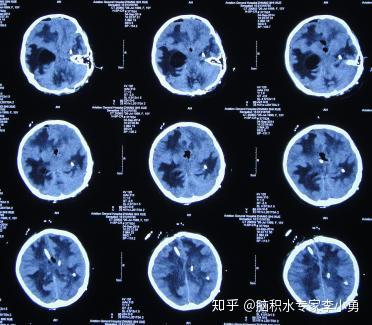 小脑蚓部髓母细胞瘤术后脑积水 4次脑室外引流术和腰大池引流术后颅内感染仍加重致脑室粘连 知乎