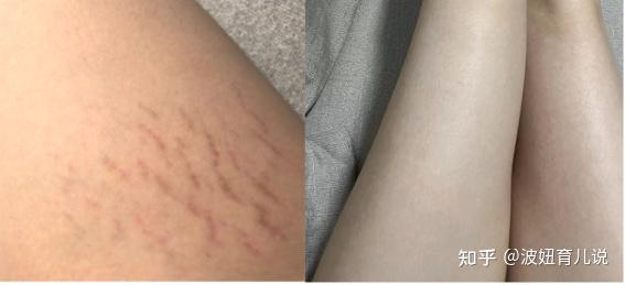 7815淡化妊娠纹,以油养肤代表