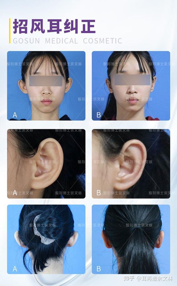 【案例分析】耳朵过于显眼自觉不美观,女孩要求做双侧招风耳矫正 - 知乎