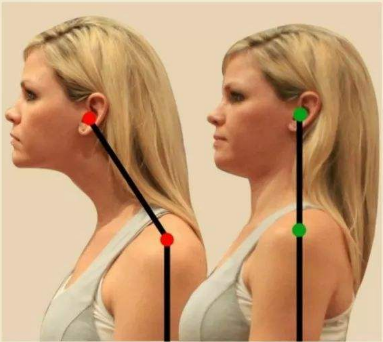 脖子前伸该怎么呢