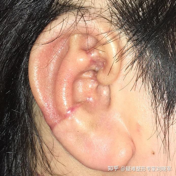 耳畸形修复再造的耳朵和真耳朵有什么区别