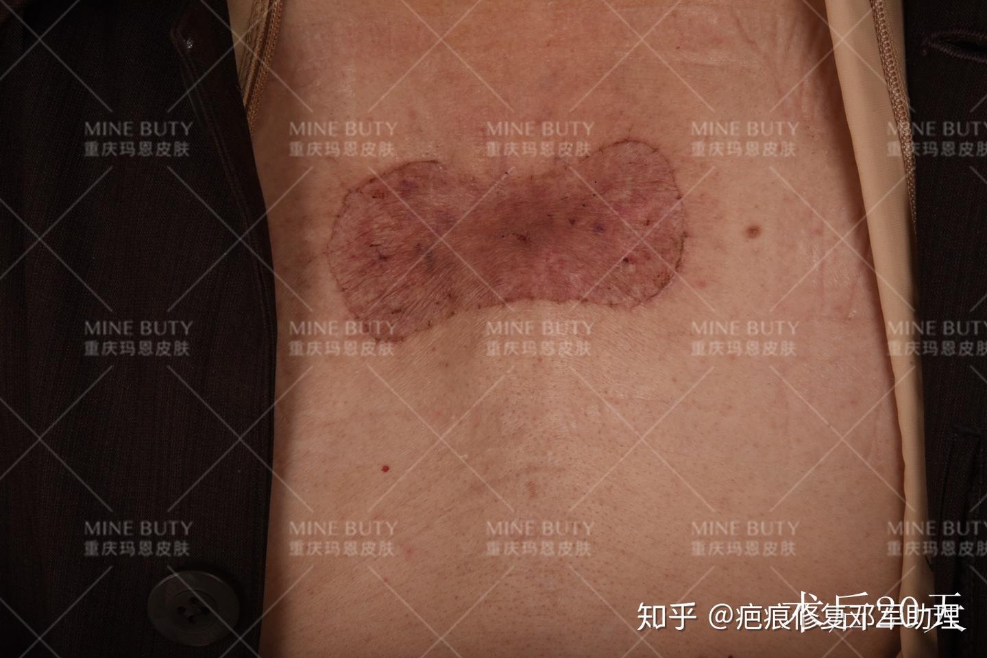 案例分享 胸前挛缩疤痕疙瘩的手术治疗 - 知乎