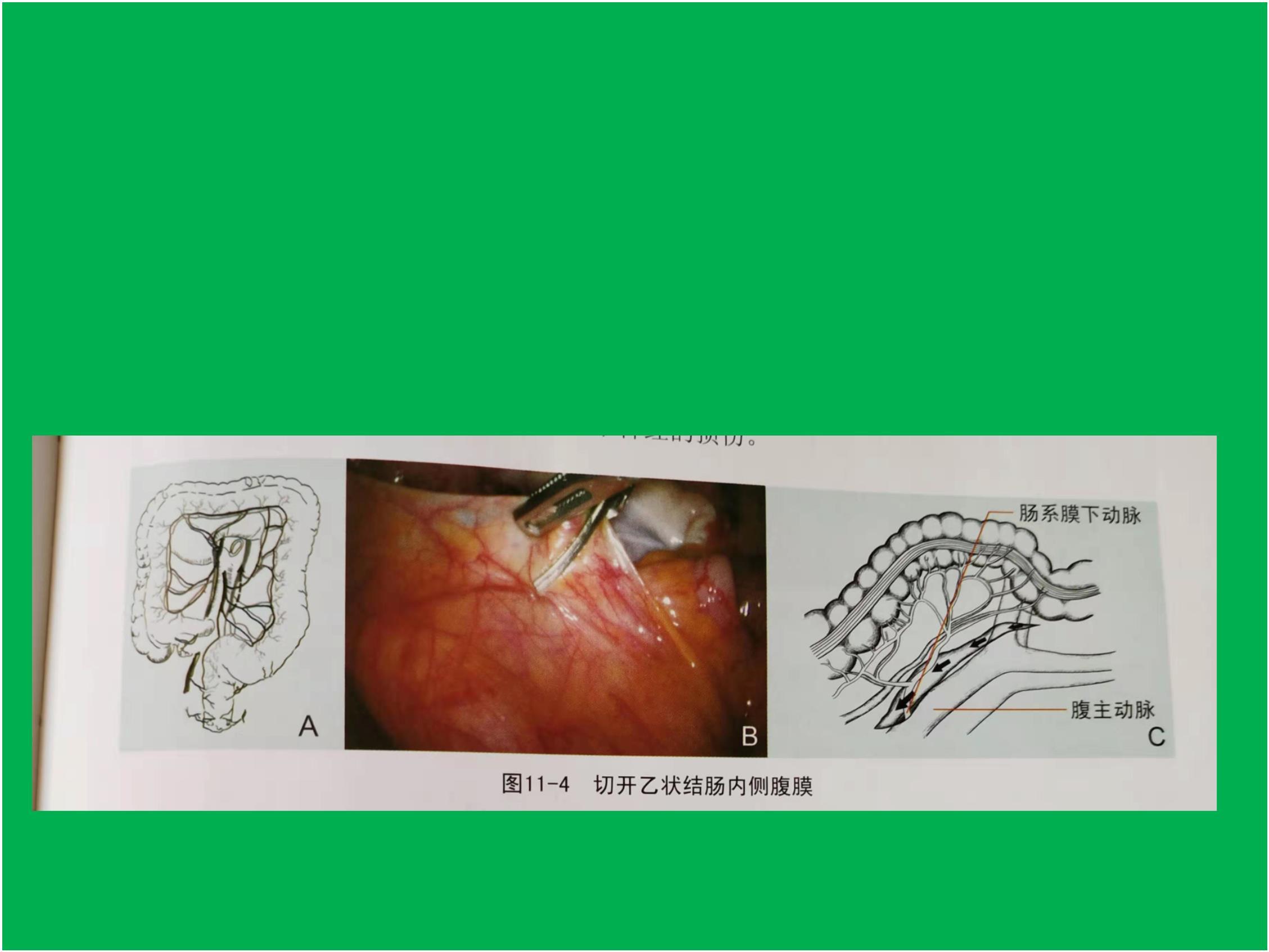 腹腔镜结肠癌根治术-手术过程