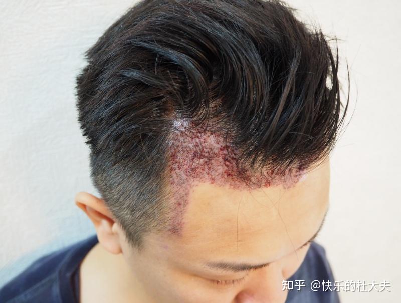 植发后抽烟了怎么补救(植发后抽烟会影响成活率吗)