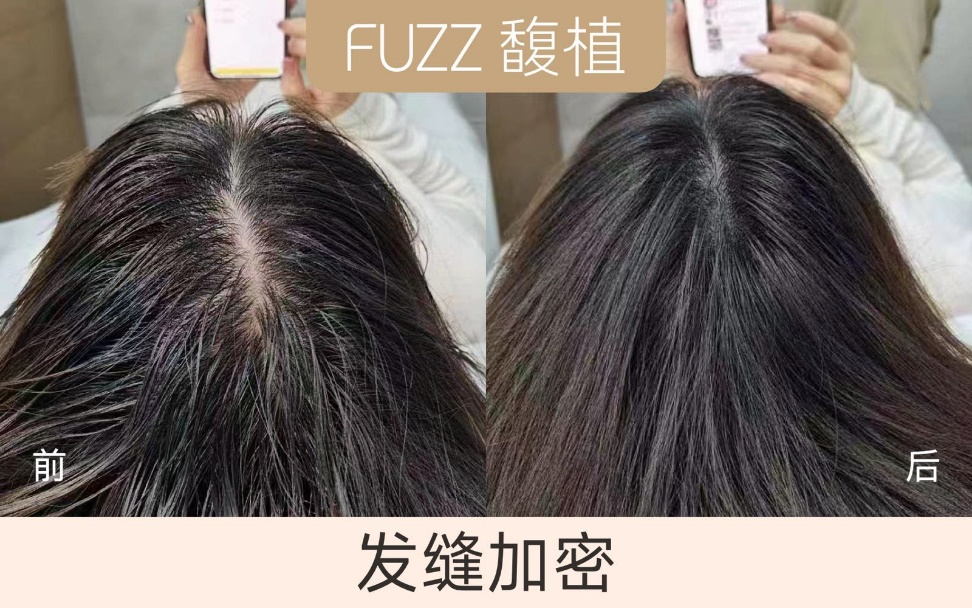 馥植纹发|还你浓密秀发！ - 知乎