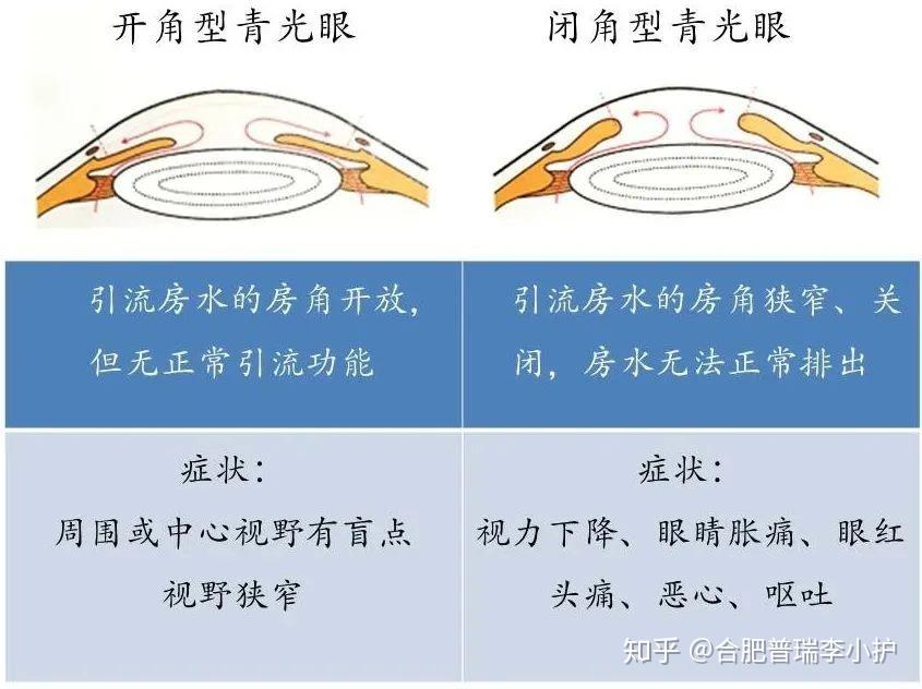 急性闭角型青光眼分期图片